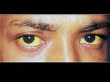 Causes And Symptoms Of Jaundice