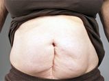 Tips To Reduce Post C-Section Belly
