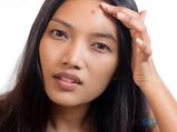 Home Remedies To Cure Acne Due To Dandruff