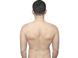 Home Remedies To Reduce Strech Marks On Back