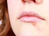 10 Natural Treatments For Lip Herpes