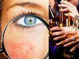 Can Alcohol Cause Acne?