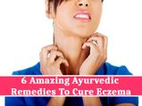 6 Amazing Ayurvedic Remedies To Cure Eczema