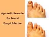 Quick Ayurvedic Remedies For Toenail Fungal Infection (Foot Care For Monsoon)