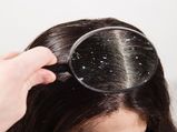 This Common Ingredient Can Reduce Dandruff In A Week!