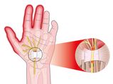 Nerve Injuries & Neuropathies Of The Hand