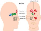 Ayurvedic Remedies To Cure Sinus
