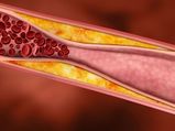Blood Clots: Know The Signs And Symptoms