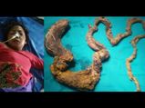This Girl Had A 5-Feet-Long Hairball In Her Stomach!!