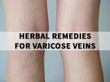 Are Varicose Veins Troubling You A Lot? Here Are 15 Herbal Remedies You Can Try