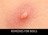 Home Remedies To Cure Boils On Skin
