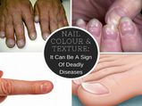 Nail Colour & Texture: It Can Be A Sign Of These Deadly Diseases!