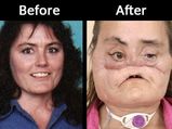 This Woman Got The First Face Transplant