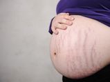 7 Foods To Reduce Stretch Marks After Child-Birth
