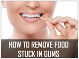 Tips To Remove Food Stuck In Gums