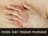 Foods That Trigger Psoriasis