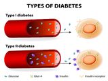 How Does Type 1 Diabetes Differ From Type 2 Diabetes?