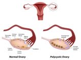 Top Foods To Be Included In A PCOS (Polycystic Ovary Syndrome) Diet