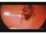 WTF! Cockroach Found In A Woman's Nose!
