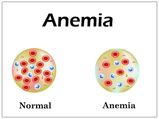 Foods For Anemia