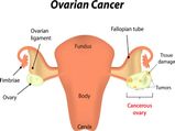 Early Symptoms Of Ovarian Cancer That You Must Be Aware Of