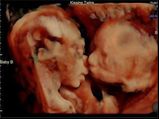 Ultrasound Photo Shows Twins Kissing!