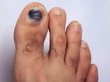 6 Dangerous Reasons Why Your Toe Nails Are Getting Darker!
