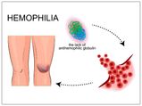 World Haemophilia Day: Lifestyle Remedies For Haemophilia
