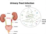 These Are The Ways Doctors Prevent The Risk Of Getting UTI (Urinary Tract Infection) Again
