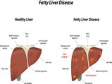 Home Remedies For Fatty Liver Disease & Foods To Avoid It