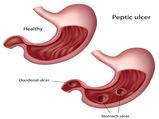 Causes Of Peptic Ulcer That You Must Know About