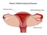 Best Natural Solutions For Pelvic Infection In Women