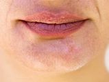 Prevent Your Lips From Getting Dry During This Monsoon