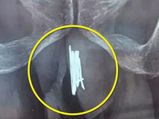 Man Who Pierced 15 Needles Into His Penis & Survived!