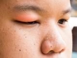 Top Causes Of Swollen Eyelids That You Need To Know About