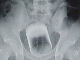 When An 8-cm Glass Was Found In A Man's Rear!