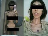 Real Life Stories: Horrific Images Of The Girl Who Was Starved By Her Grandfather