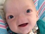 Real-life Story Of The Boy Who Was Born Without Nose