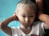 What Is Ichthyosis? Know More About The Rare Condition