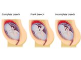 Natural Ways To Turn A Breech Baby