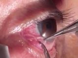 WTF! Doctor Pulls Out A 15-cm Long Worm From A Man's Eye!