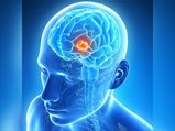 World Brain Tumour Day: What Are The Chances Of Surviving Glioblastoma?