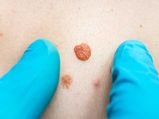Skin Tags In Children: Causes And Treatment