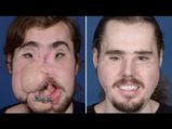 Depressed Man Who Shot Himself Gets A Face Transplant