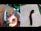 Video Alert: Her Throat Tumour Turned Out To Be A Living Leech Instead!