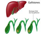 Gallstones: Natural Remedies, Foods To Eat & Avoid