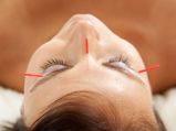 Does Acupuncture Really Help In Weight Loss?