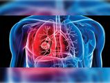 World Tuberculosis Day: Ayurvedic Treatment For Pulmonary Tuberculosis
