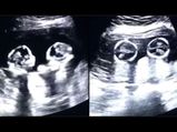 Video Of Twins ‘Fighting’ Inside Mother’s Womb During Ultrasound Is Going Viral