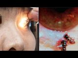 Woman Had Bees Living In Her Eye!